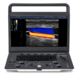 портативный узи аппарат