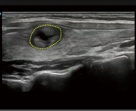 S-Thyroid
